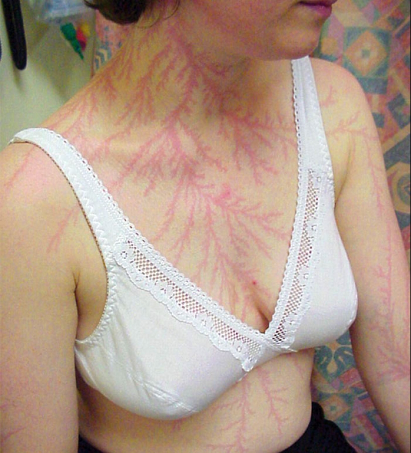 Después de la descarga: ¿qué le sucede a un hombre que fue alcanzado por un rayo