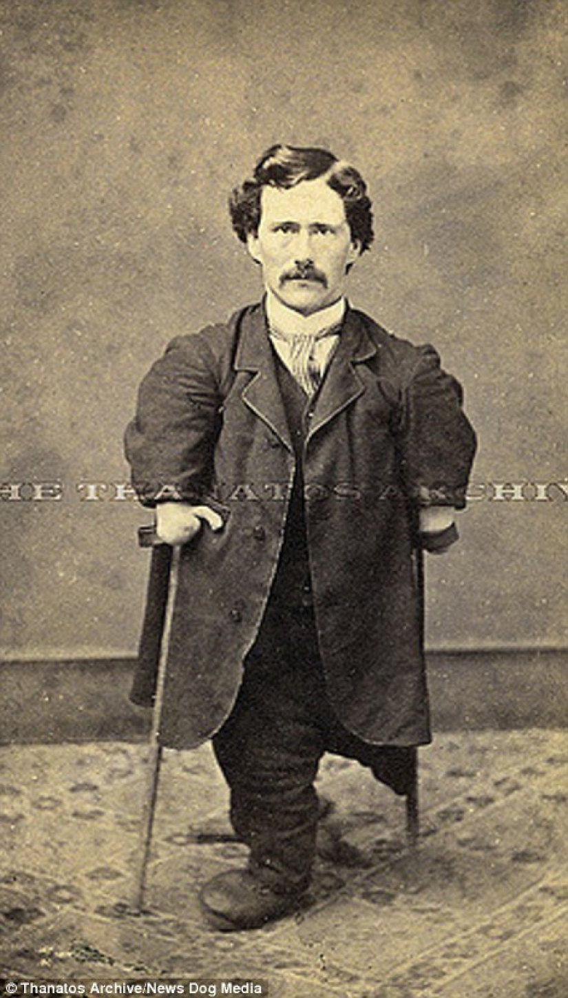 El duro siglo XIX: una colección de fotografías de archivo de personas con deformidades El duro siglo XIX: una colección de fotografías de archivo de personas con deformidades