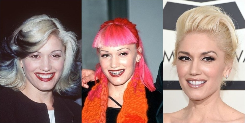 Estas celebridades le mostrarán cómo los frenillos pueden cambiar drásticamente su sonrisa.