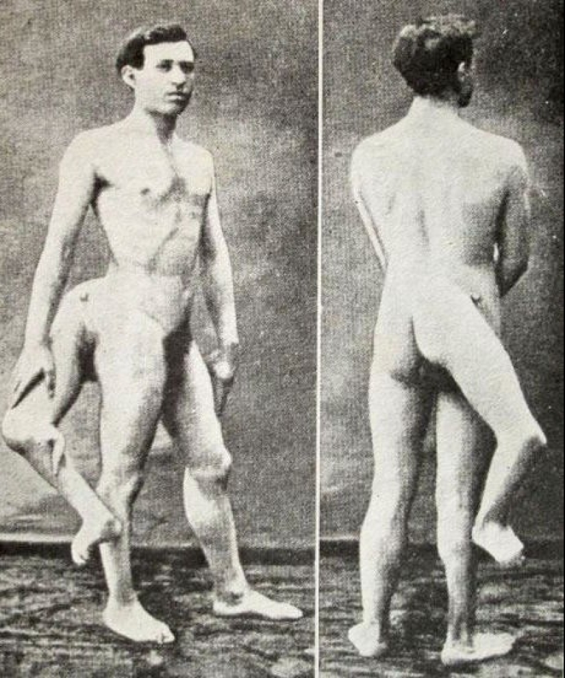 Francesco Lentini - the three-legged "king of freaks" who conquered America Francesco Lentini - the three-legged "king of freaks" who conquered America
