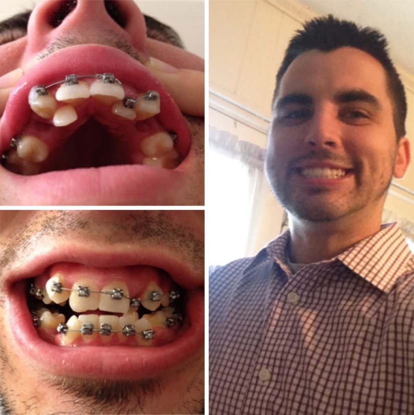 Here's how radically braces change a smile and life