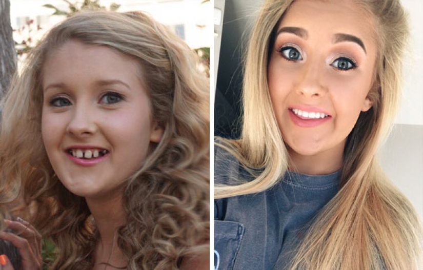 Here's how radically braces change a smile and life