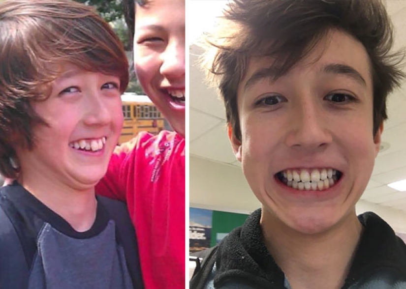 Here's how radically braces change a smile and life