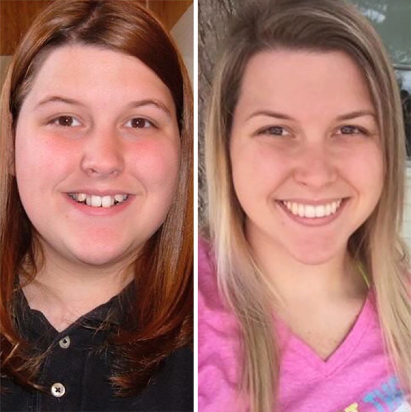 Here's how radically braces change a smile and life