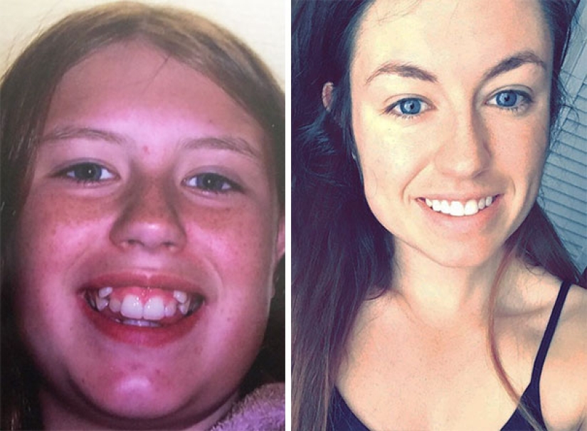 Here's how radically braces change a smile and life