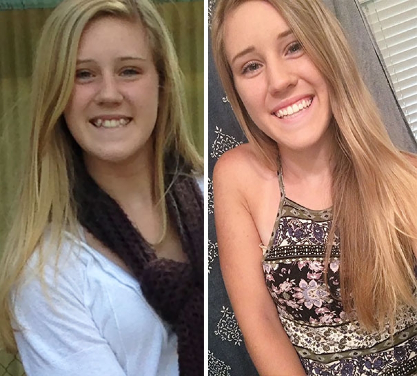 Here's how radically braces change a smile and life