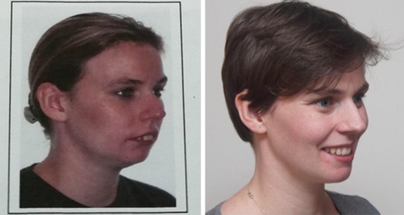 Here's how radically braces change a smile and life