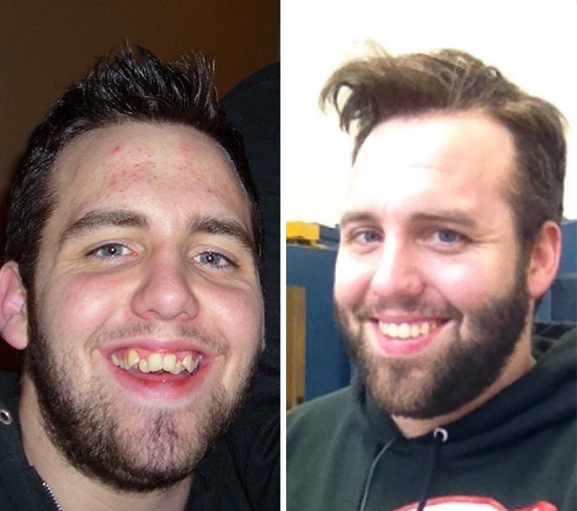 Here's how radically braces change a smile and life