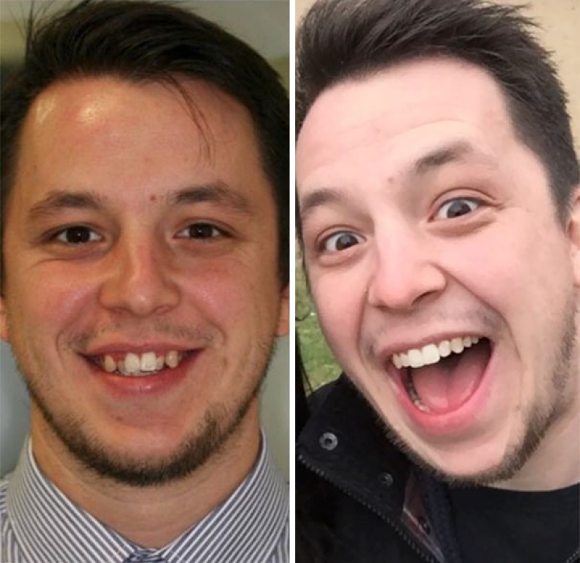 Here's how radically braces change a smile and life