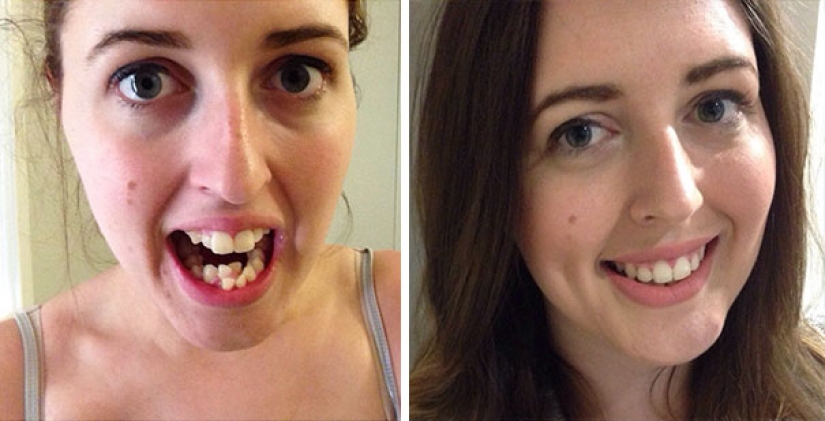 Here's how radically braces change a smile and life