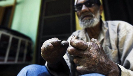 History of leprosy: why humanity has conquered, but not defeated "lazy death"