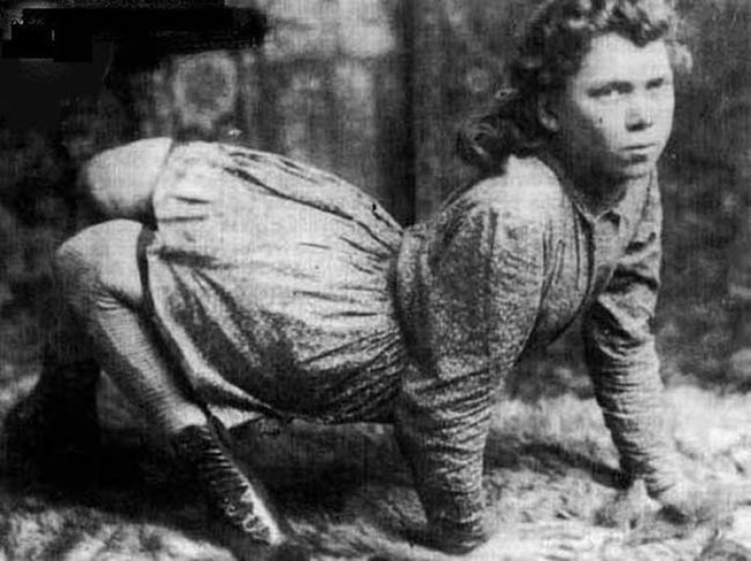 It's hard to believe, but these 5 people with anomalies really existed!