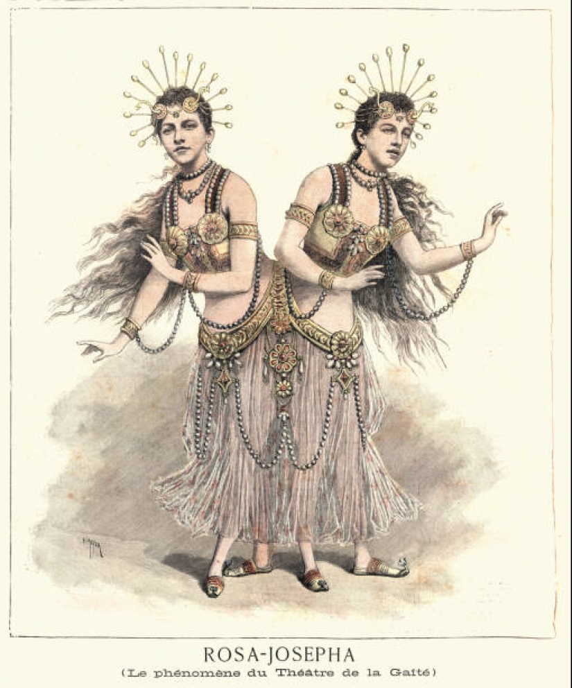 La historia de dos siamesas, las hermanas Blazek, una de las cuales dio a luz a un niño.