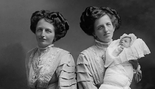 La historia de dos siamesas, las hermanas Blazek, una de las cuales dio a luz a un niño.