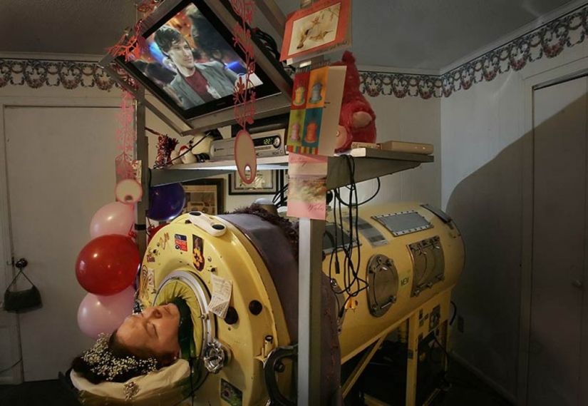 Life in the "tank": a woman has spent almost 60 years in the lung