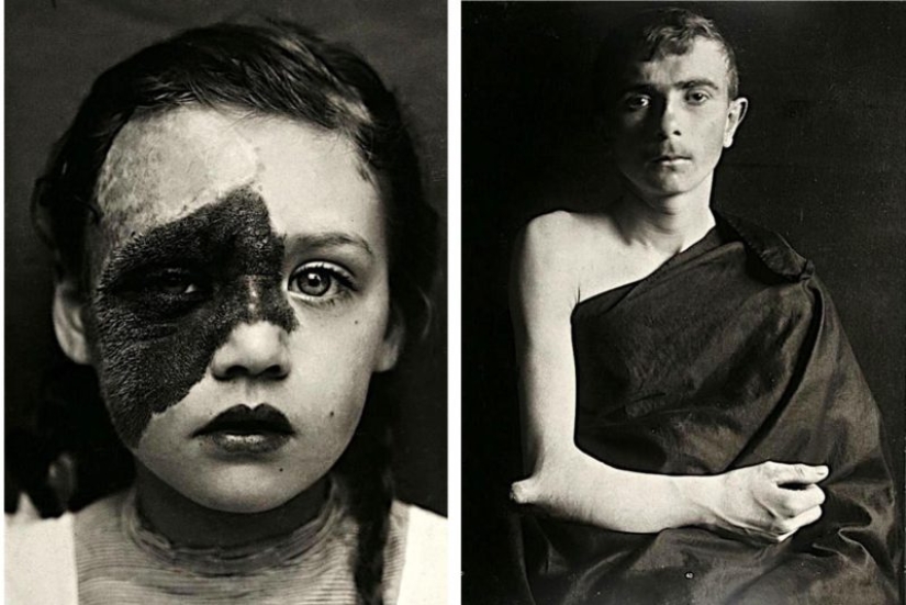 Portraits of pain: striking photographs of patients from nineteenth-century suffering from serious illnesses Portraits of pain: striking photographs of patients from nineteenth-century suffering from serious illnesses