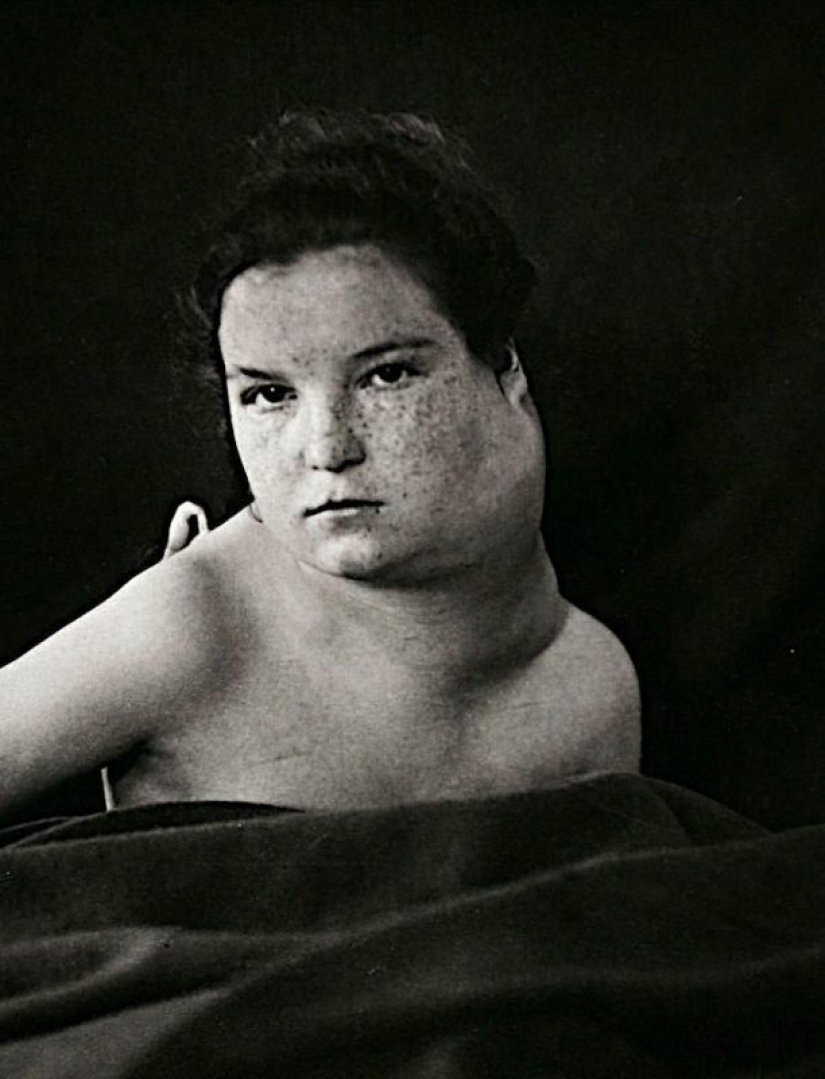 Portraits of pain: striking photographs of patients from nineteenth-century suffering from serious illnesses Portraits of pain: striking photographs of patients from nineteenth-century suffering from serious illnesses