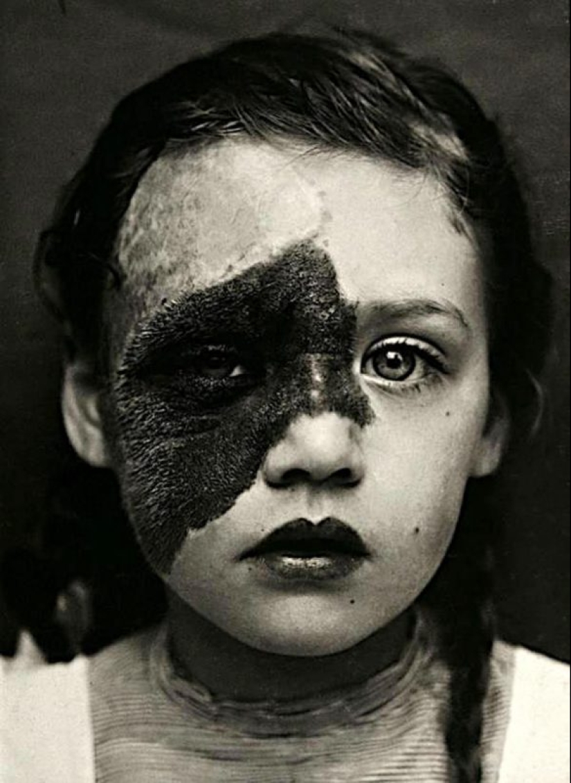 Portraits of pain: striking photographs of patients from nineteenth-century suffering from serious illnesses Portraits of pain: striking photographs of patients from nineteenth-century suffering from serious illnesses