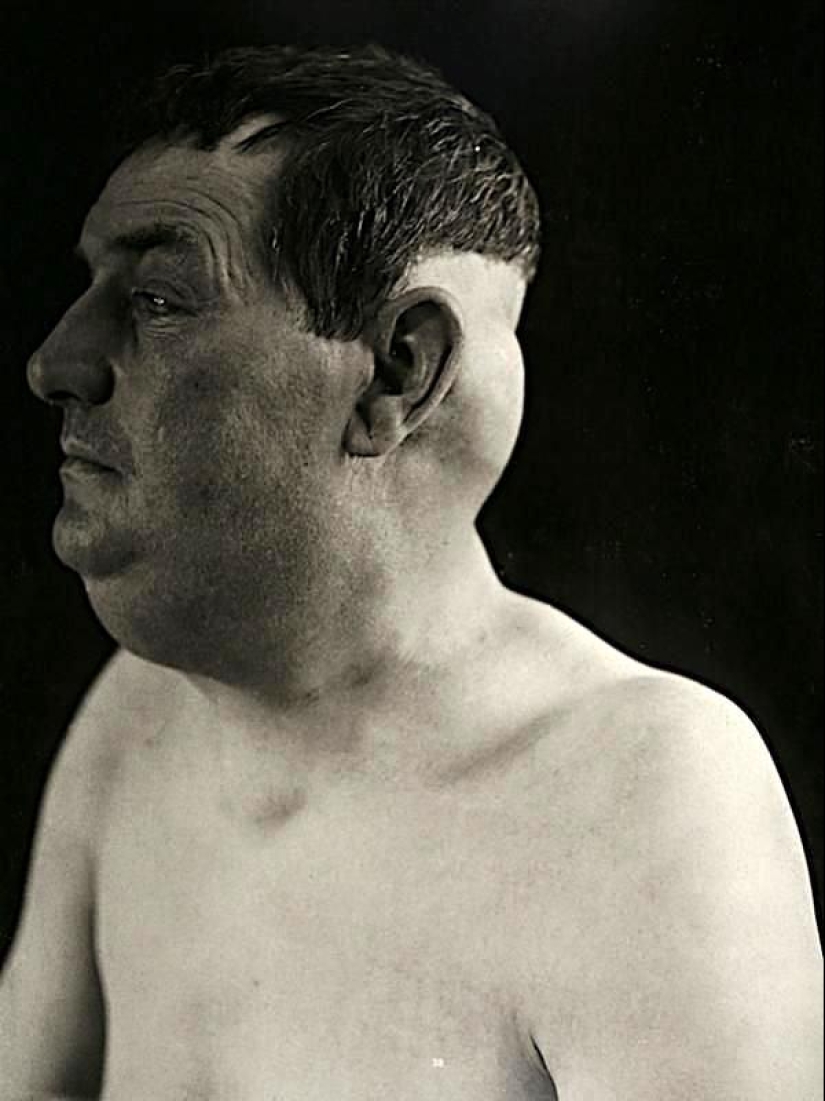 Portraits of pain: striking photographs of patients from nineteenth-century suffering from serious illnesses Portraits of pain: striking photographs of patients from nineteenth-century suffering from serious illnesses