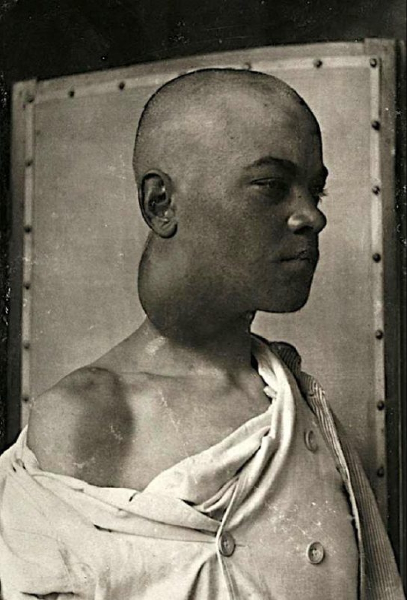Portraits of pain: striking photographs of patients from nineteenth-century suffering from serious illnesses Portraits of pain: striking photographs of patients from nineteenth-century suffering from serious illnesses