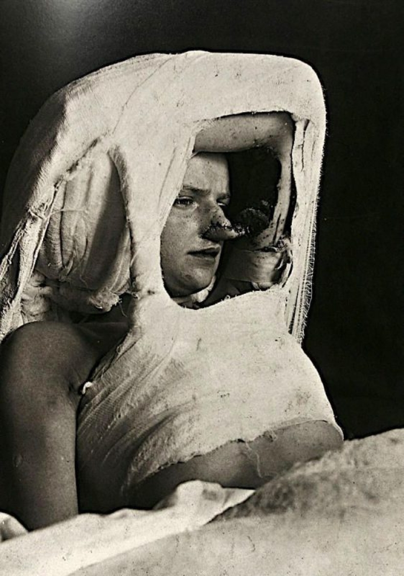 Portraits of pain: striking photographs of patients from nineteenth-century suffering from serious illnesses Portraits of pain: striking photographs of patients from nineteenth-century suffering from serious illnesses