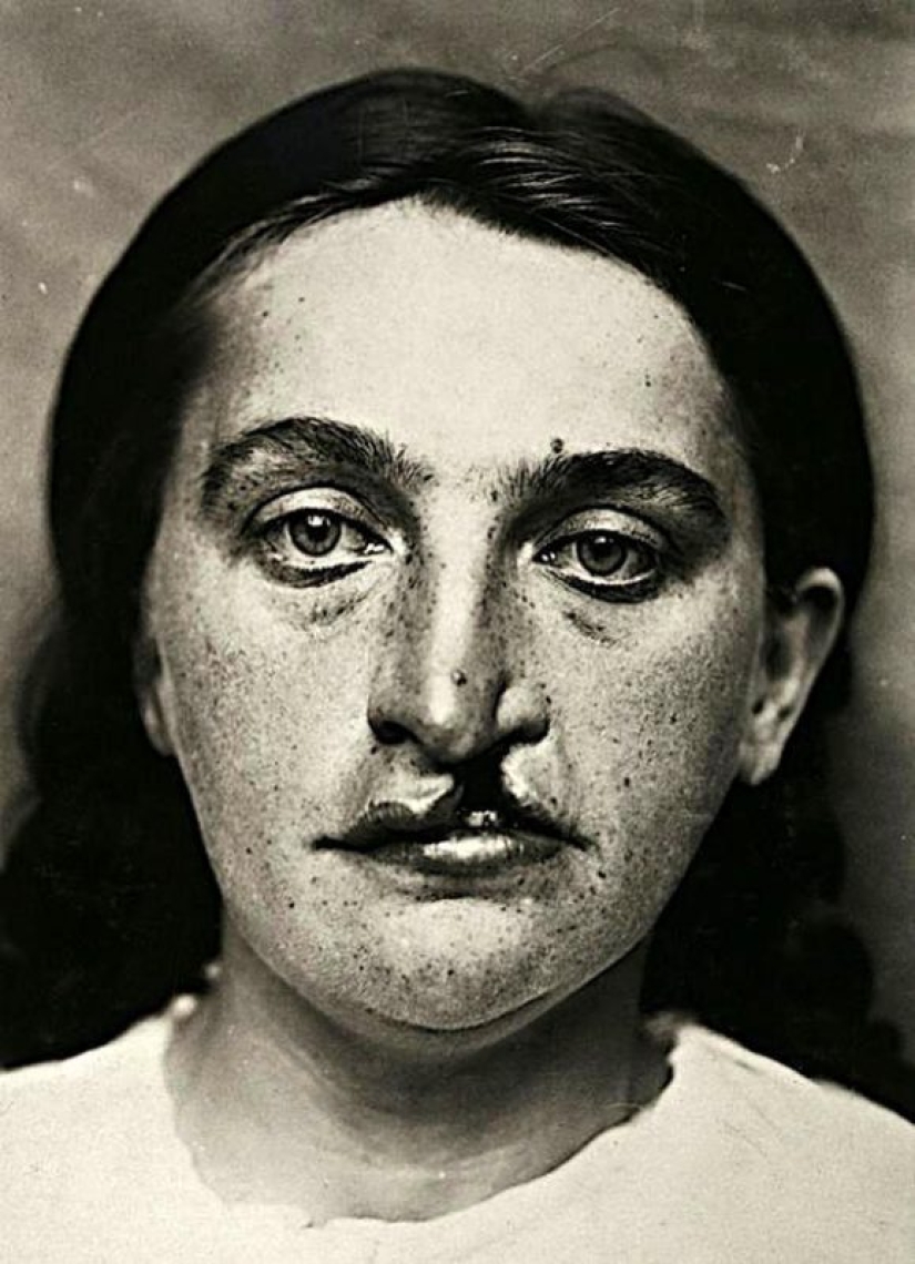 Portraits of pain: striking photographs of patients from nineteenth-century suffering from serious illnesses Portraits of pain: striking photographs of patients from nineteenth-century suffering from serious illnesses