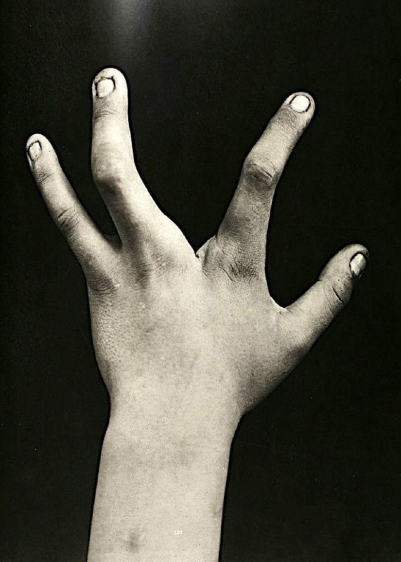 Portraits of pain: striking photographs of patients from nineteenth-century suffering from serious illnesses Portraits of pain: striking photographs of patients from nineteenth-century suffering from serious illnesses