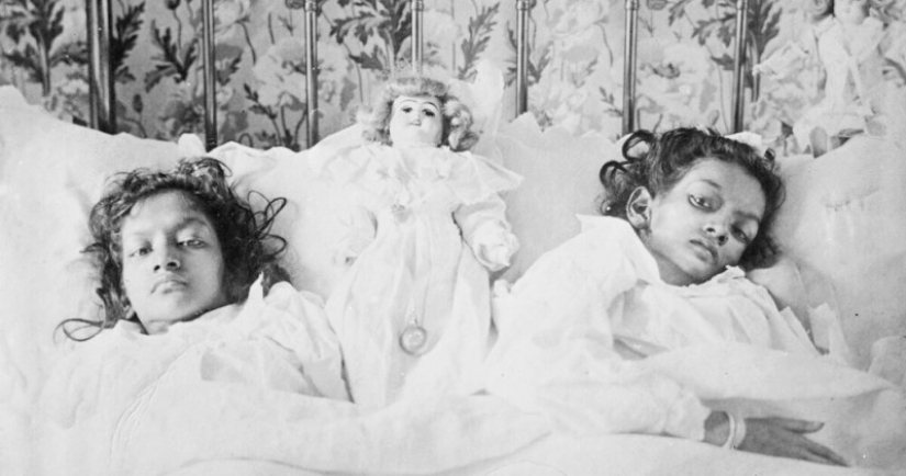 Radhika and Dudika Neik: The tragic fate of conjoined twins who were unfortunately separated