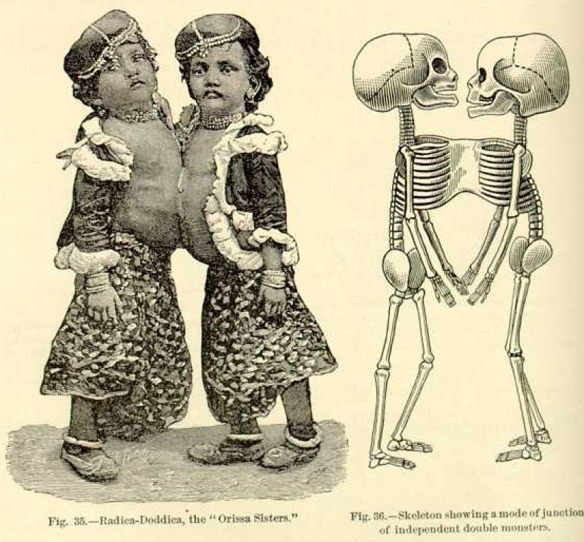 Radhika and Dudika Neik: The tragic fate of conjoined twins who were unfortunately separated