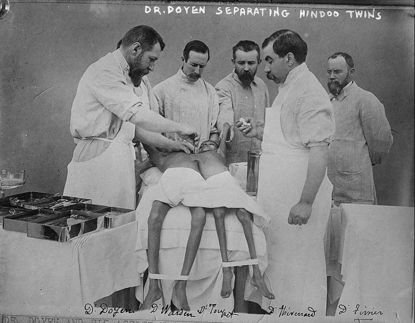 Radhika y Dudika Neik: El trágico destino de las siamesas que lamentablemente fueron separadas