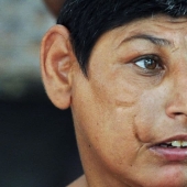 "Rats of Shah Daula": children from Pakistan with deformed skulls and a hard fate "Rats of Shah Daula": children from Pakistan with deformed skulls and a hard fate