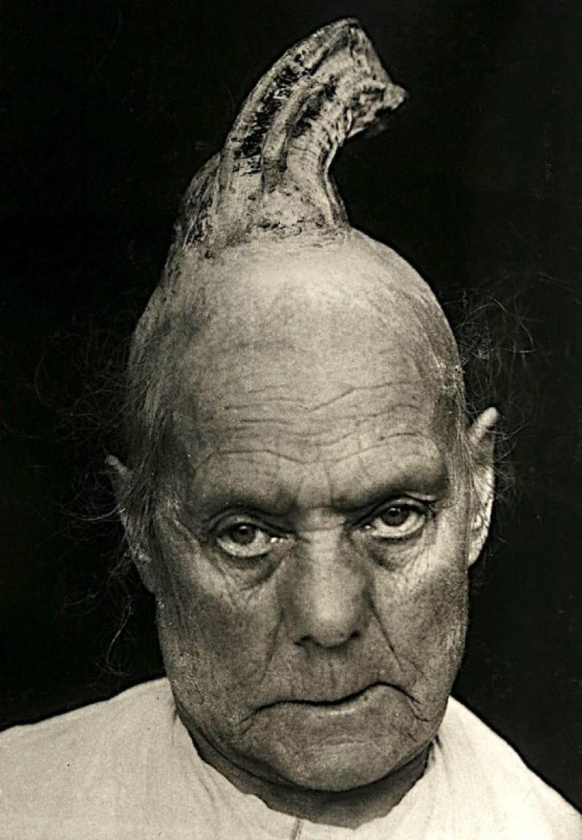 Retratos de dolor: impactantes fotografías de los pacientes a partir del siglo xix que sufren de enfermedades graves