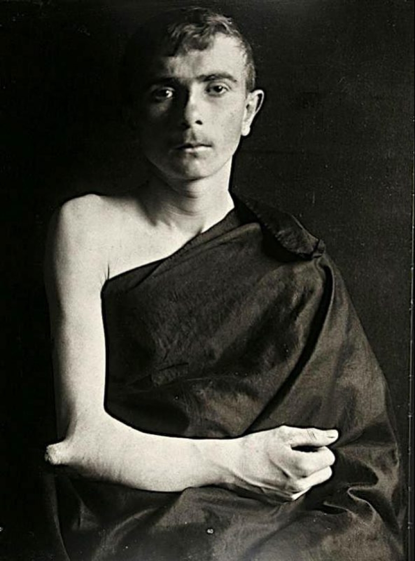 Retratos de dolor: impactantes fotografías de los pacientes a partir del siglo xix que sufren de enfermedades graves