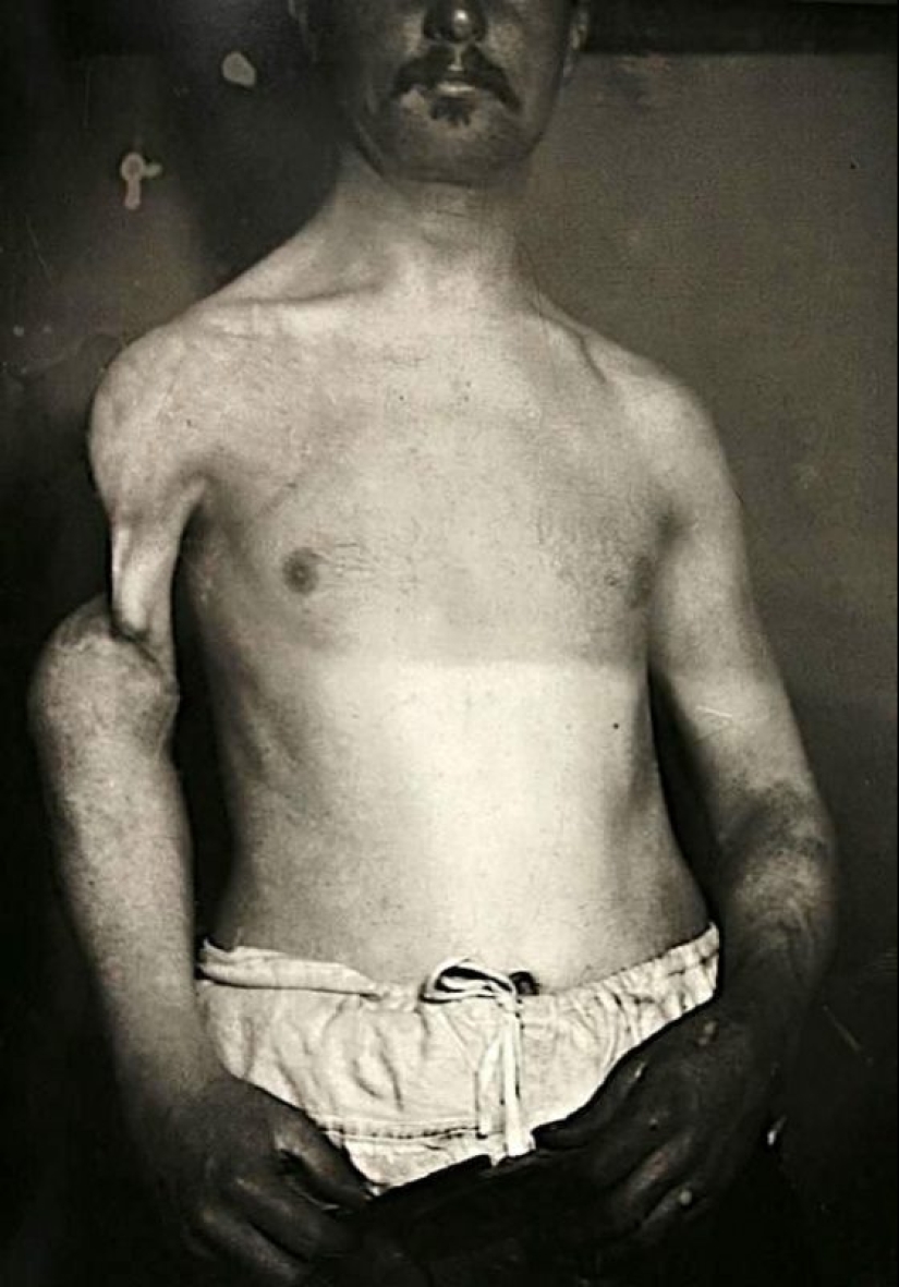 Retratos de dolor: impactantes fotografías de los pacientes a partir del siglo xix que sufren de enfermedades graves