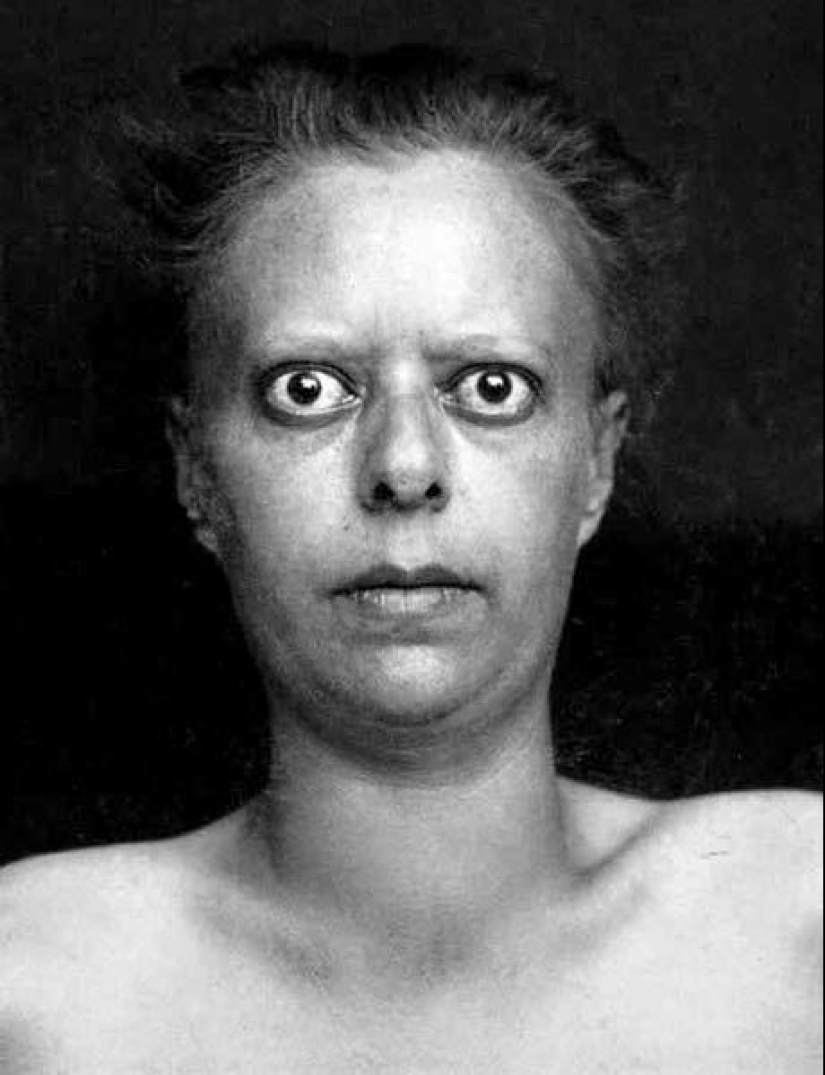 Retratos de dolor: impactantes fotografías de los pacientes a partir del siglo xix que sufren de enfermedades graves