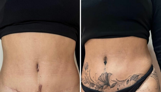 Tattoo Artist Covers Scars With Delicate Designs, And Here Are Her 10 Best Transformations Tattoo Artist Covers Scars With Delicate Designs, And Here Are Her 10 Best Transformations