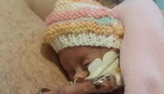 The amazing story of a tiny baby who survived no matter what The amazing story of a tiny baby who survived no matter what