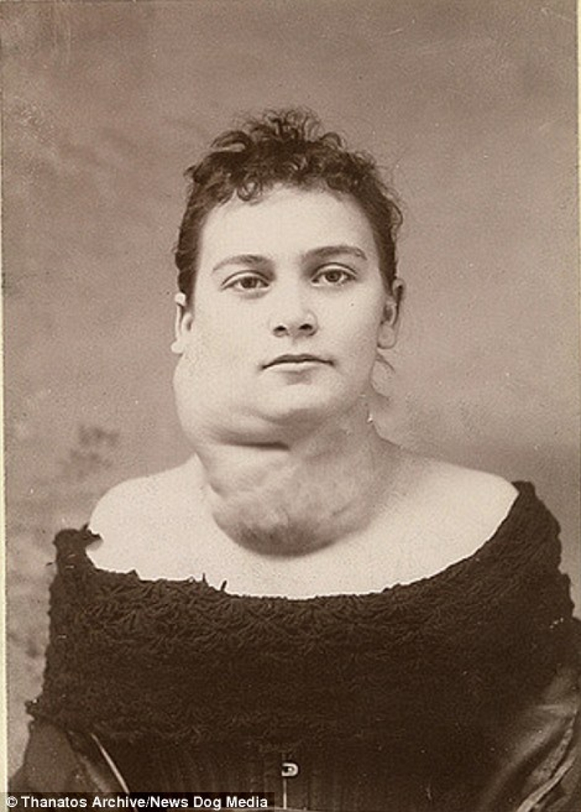The harsh 19th century: a collection of archival photographs of people with deformities The harsh 19th century: a collection of archival photographs of people with deformities