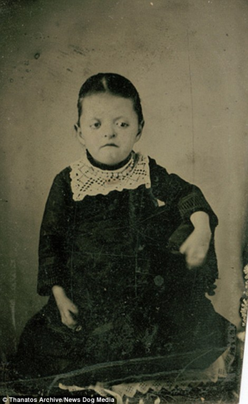 The harsh 19th century: a collection of archival photographs of people with deformities The harsh 19th century: a collection of archival photographs of people with deformities