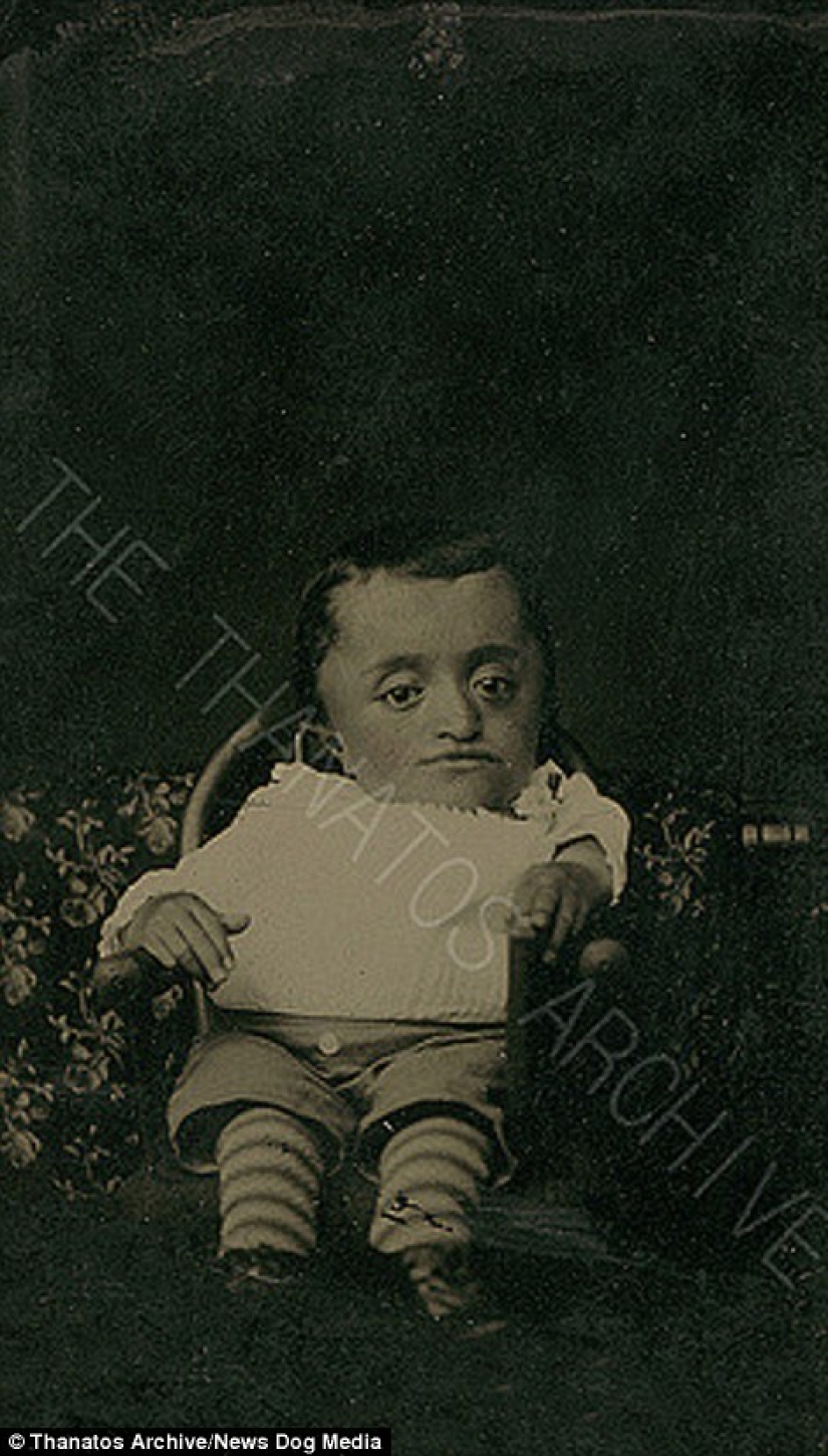 The harsh 19th century: a collection of archival photographs of people with deformities The harsh 19th century: a collection of archival photographs of people with deformities