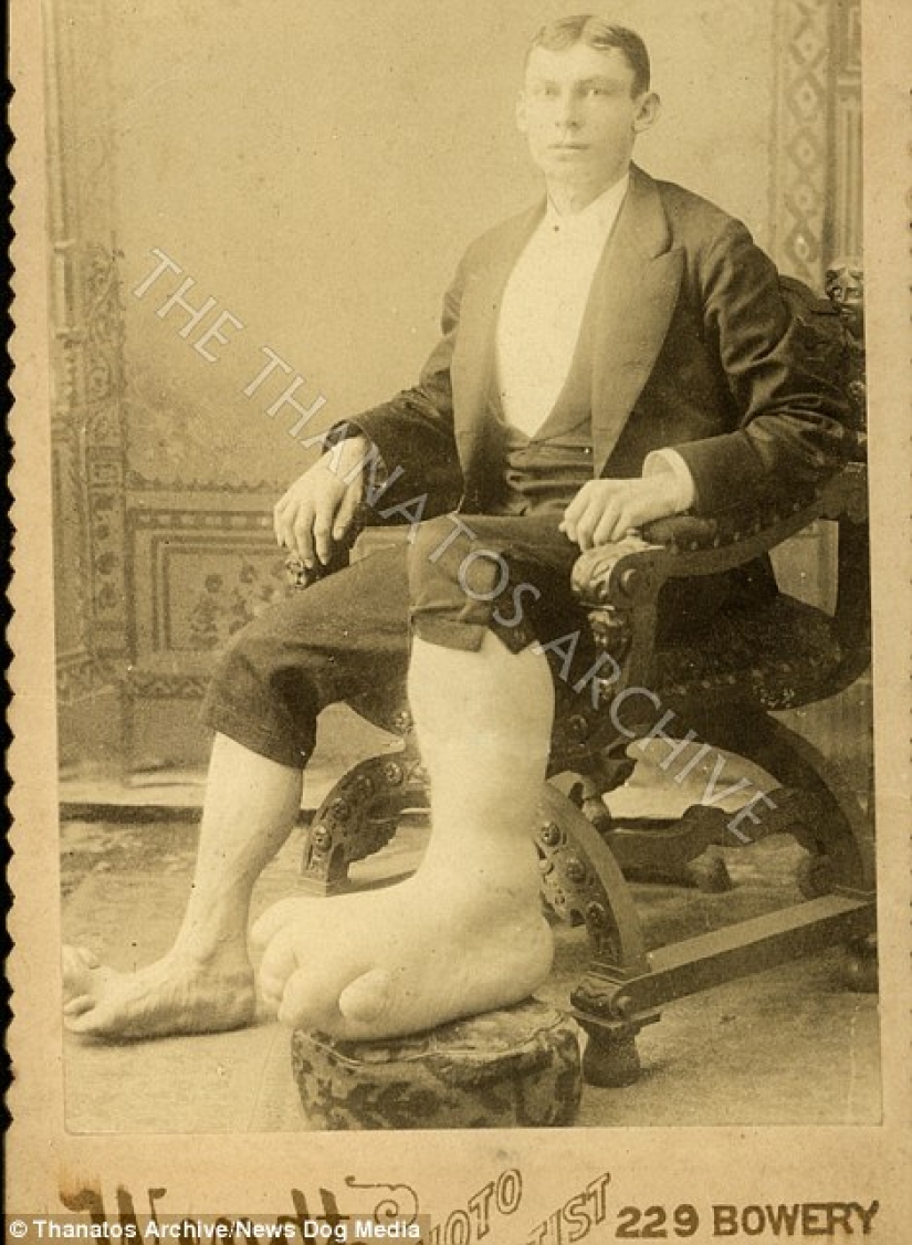 The harsh 19th century: a collection of archival photographs of people with deformities The harsh 19th century: a collection of archival photographs of people with deformities