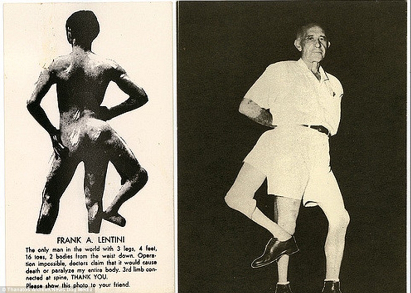 The harsh 19th century: a collection of archival photographs of people with deformities The harsh 19th century: a collection of archival photographs of people with deformities