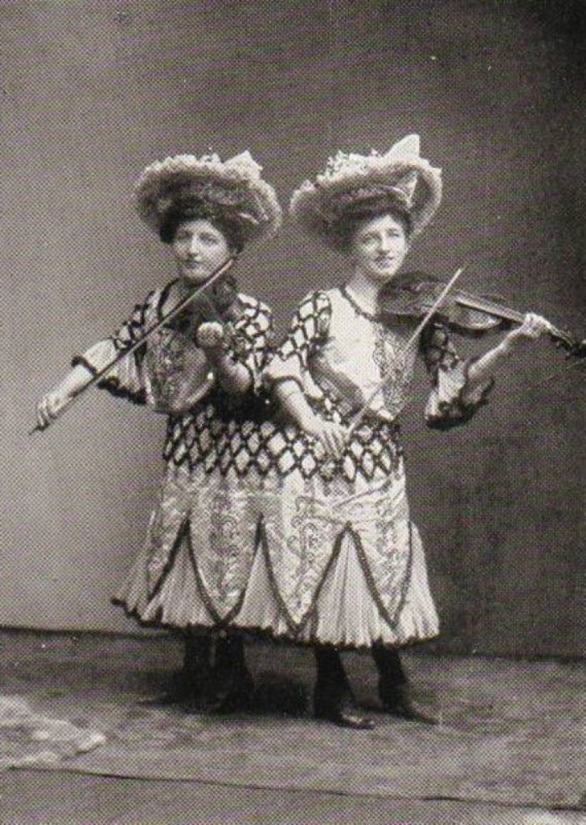 The story of conjoined twins, the Blazek sisters, one of whom gave birth to a child The story of conjoined twins, the Blazek sisters, one of whom gave birth to a child