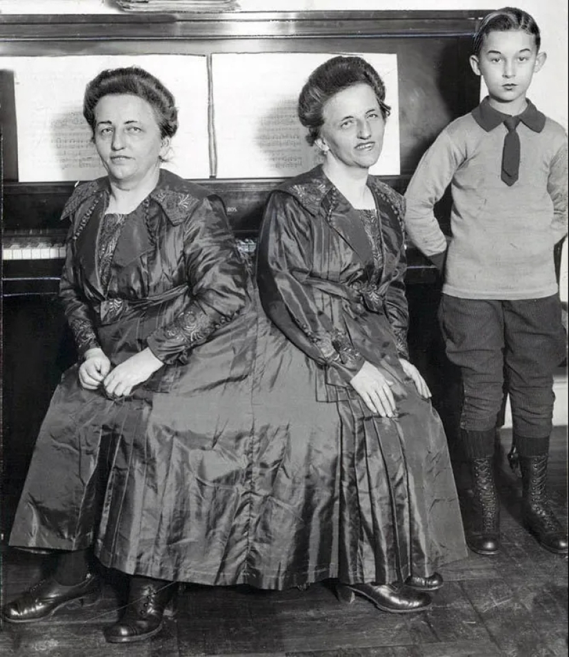 The story of conjoined twins, the Blazek sisters, one of whom gave birth to a child The story of conjoined twins, the Blazek sisters, one of whom gave birth to a child