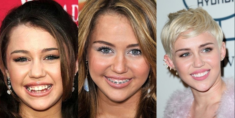 These celebrities will show you how braces can dramatically change your smile.