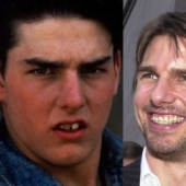 These celebrities will show you how braces can dramatically change your smile.