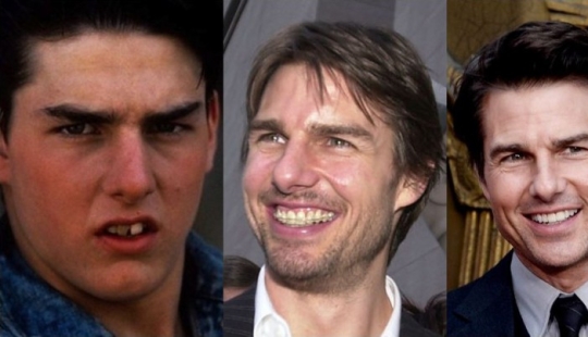 These celebrities will show you how braces can dramatically change your smile. These celebrities will show you how braces can dramatically change your smile.