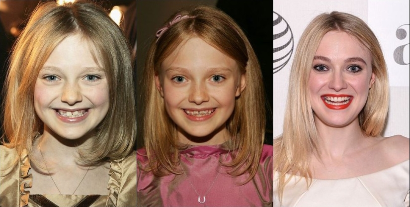 These celebrities will show you how braces can dramatically change your smile.