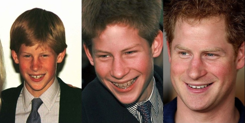 These celebrities will show you how braces can dramatically change your smile.