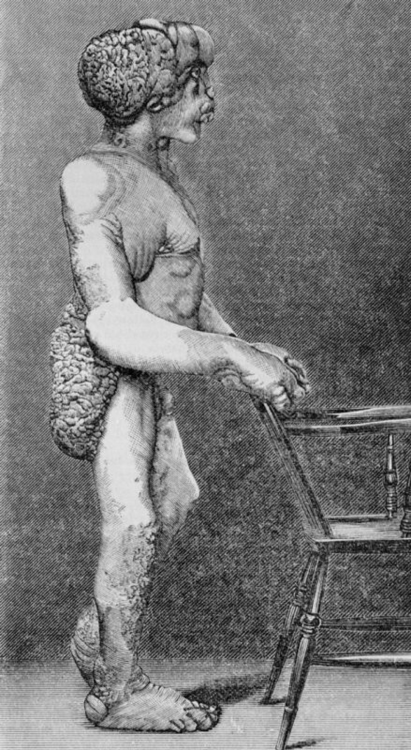 Un Fenómeno con un Alma Hermosa: La historia de Joseph Merrick - El Hombre Elefante